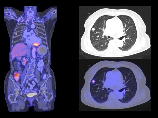 肺癌　PET画像